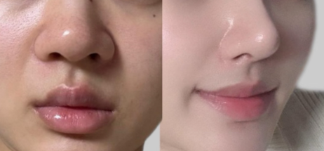 IPL Photofacial: Say Goodbye to Sunspots and Redness缩略图