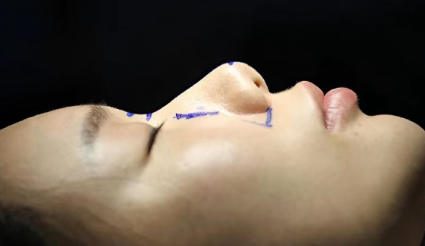 A complete breakdown of the rhinoplasty procedure, including pricing, surgical techniques, and recovery time.插图1