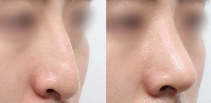 A complete breakdown of the rhinoplasty procedure, including pricing, surgical techniques, and recovery time.插图2
