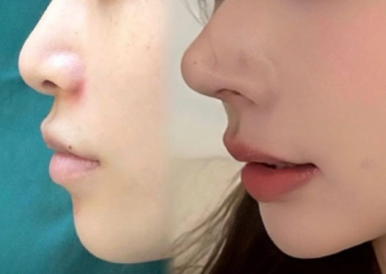 A complete breakdown of the rhinoplasty procedure, including pricing, surgical techniques, and recovery time.缩略图