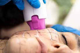 A revolution in non-invasive anti-aging: How does Thermage use “thermal energy” to reshape youth?插图2