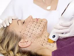 A revolution in non-invasive anti-aging: How does Thermage use “thermal energy” to reshape youth?插图3