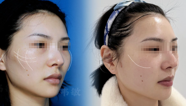 Popular Science Article on Zygomatic (Cheekbone) Reduction Surgery插图1 Popular Science Article on Zygomatic (Cheekbone) Reduction Surgery插图1