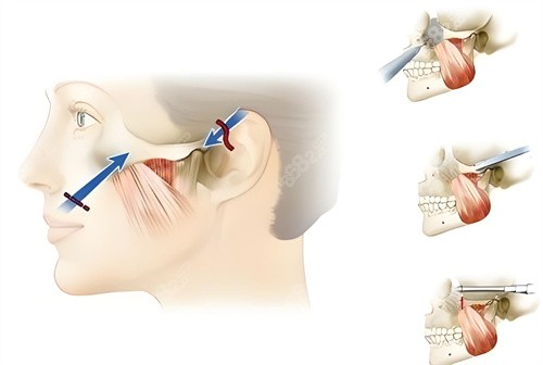 Popular Science Article on Zygomatic (Cheekbone) Reduction Surgery插图3 Popular Science Article on Zygomatic (Cheekbone) Reduction Surgery插图3