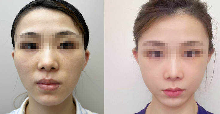 Popular Science Article on Zygomatic (Cheekbone) Reduction Surgery插图 Popular Science Article on Zygomatic (Cheekbone) Reduction Surgery插图
